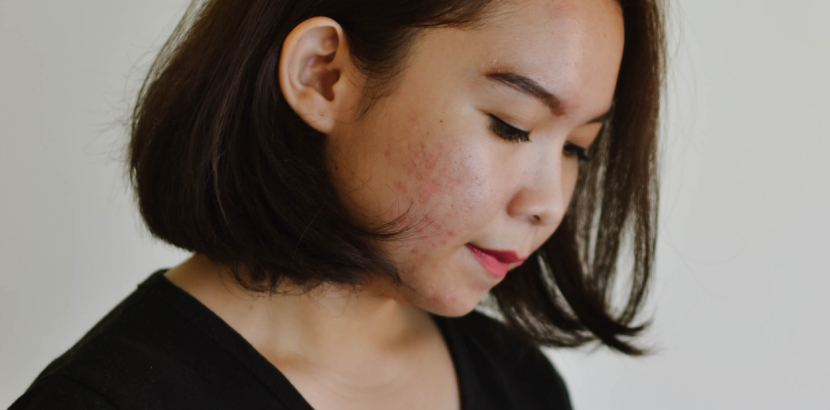 Verdacht auf Akne? Wirksame Hilfe durch Ihre Dermatologie in Zürich